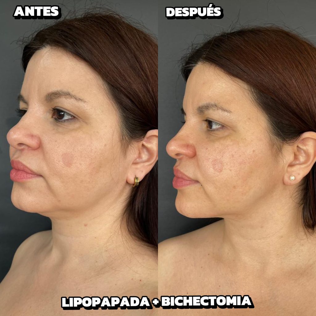 Bichectomía para una cara más definida Bichectomía para una cara más definida